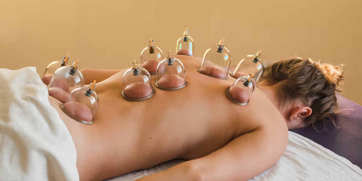 Cupping Therapy